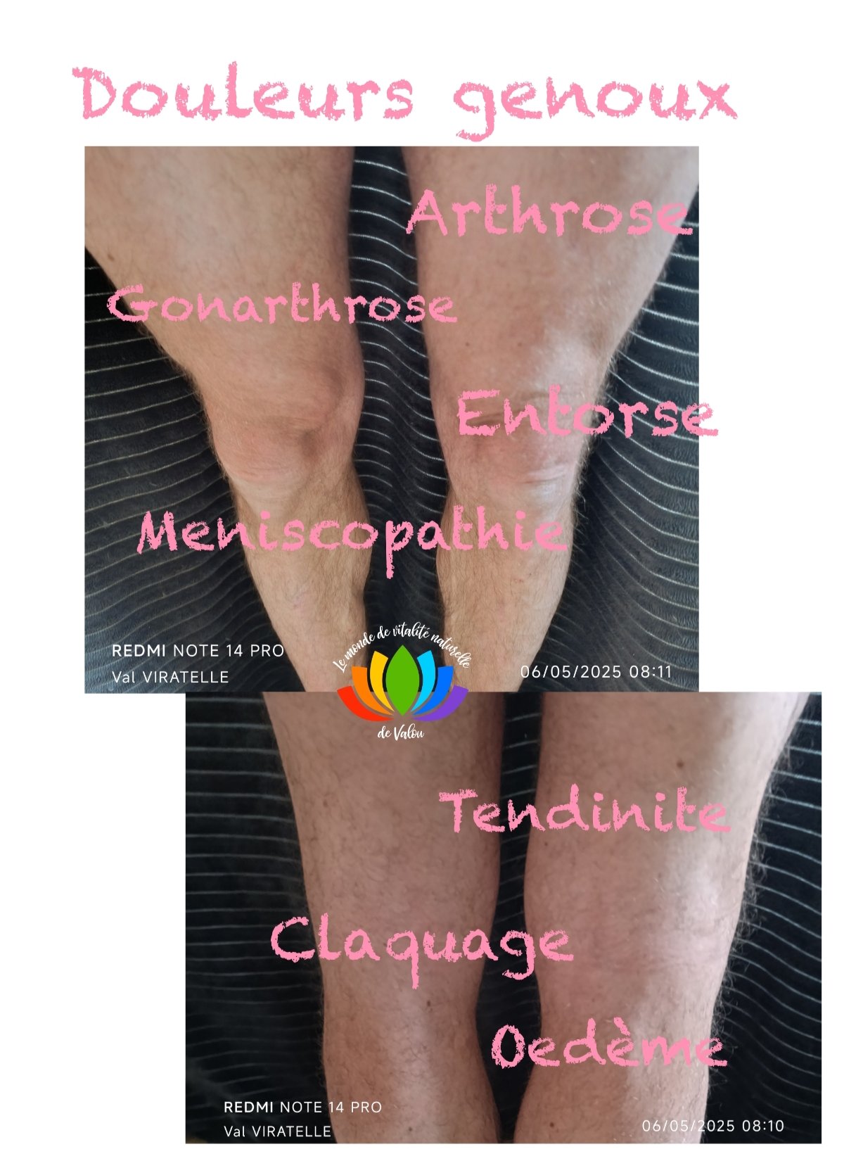 Une photo montrant les genoux et tibias d'un homme pour illustrer des zones de douleurs