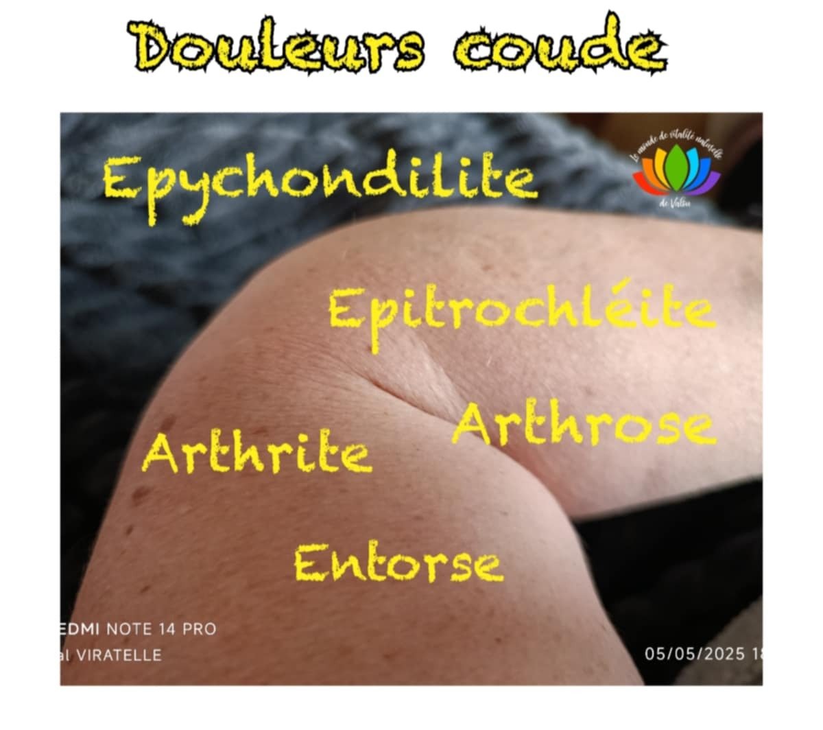 Une photo d'un coude servant à illustrer certains type de douleurs