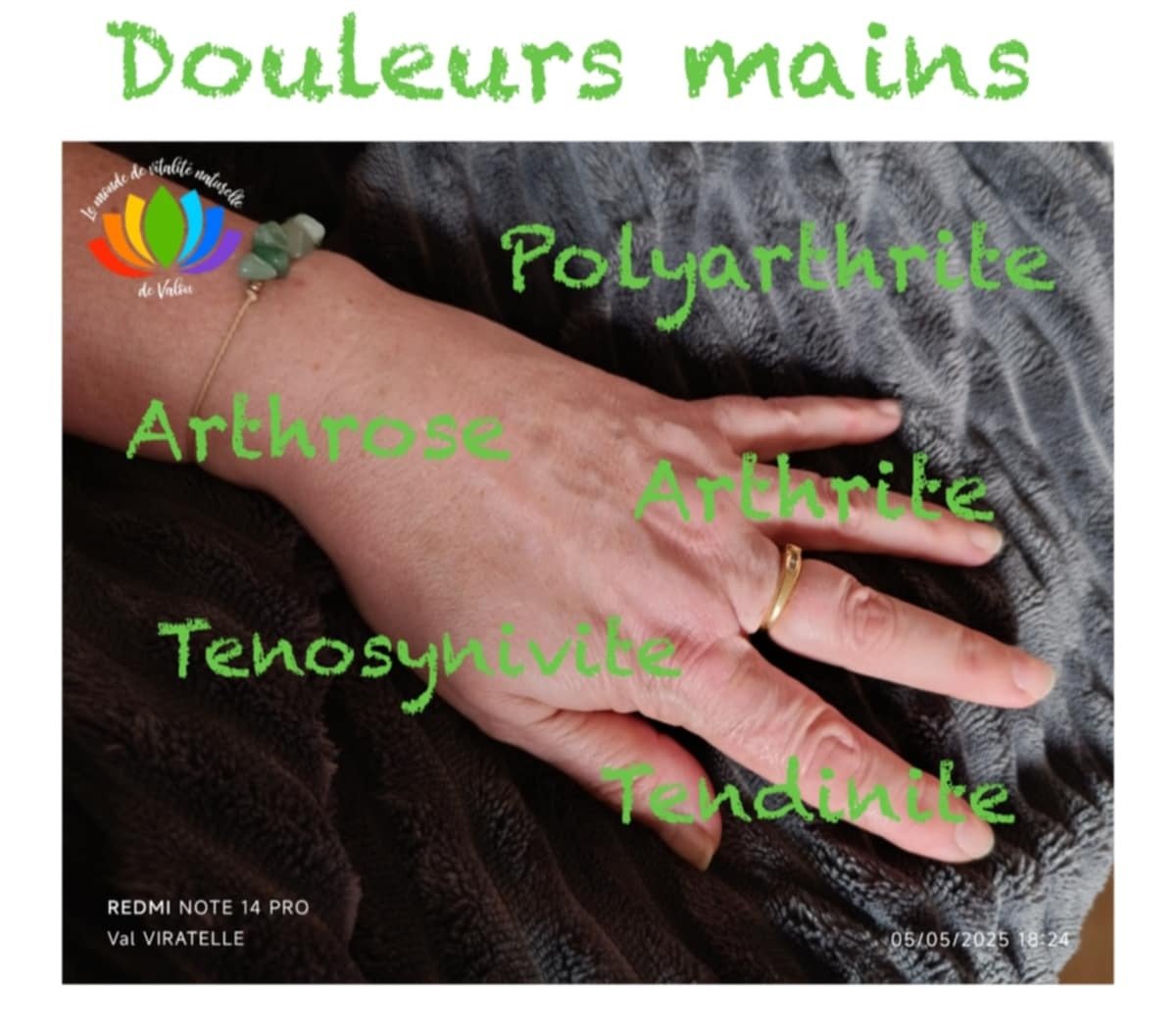 Une photo d'une main servant à illustrer des types de douleurs articulaires